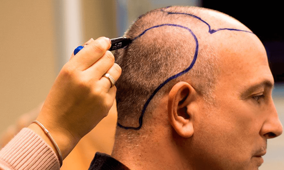 Is Hair Transplantation Performed On The Scar? | Newlyme