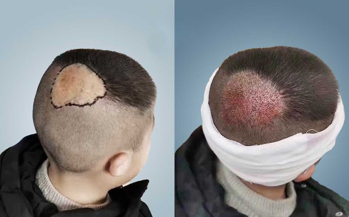 hairtransplant to the scar