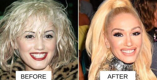 Gwen Stefani lip filler before and after