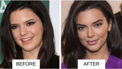 Kendall Jenner lip filler before and after