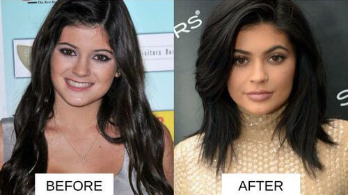 Kylie Jenner lip filler before and after