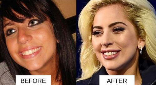 Lady Gaga lip filler before and after