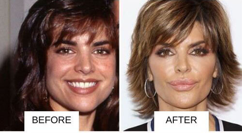 Lisa Rinna lip filler before and after