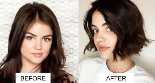 Lucy Hale lip filler before and after