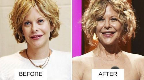 Meg Ryan lip filler before and after