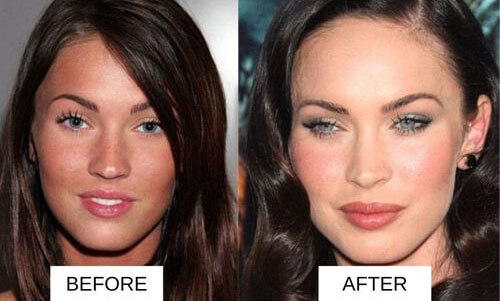 Megan Fox lip filler before and after