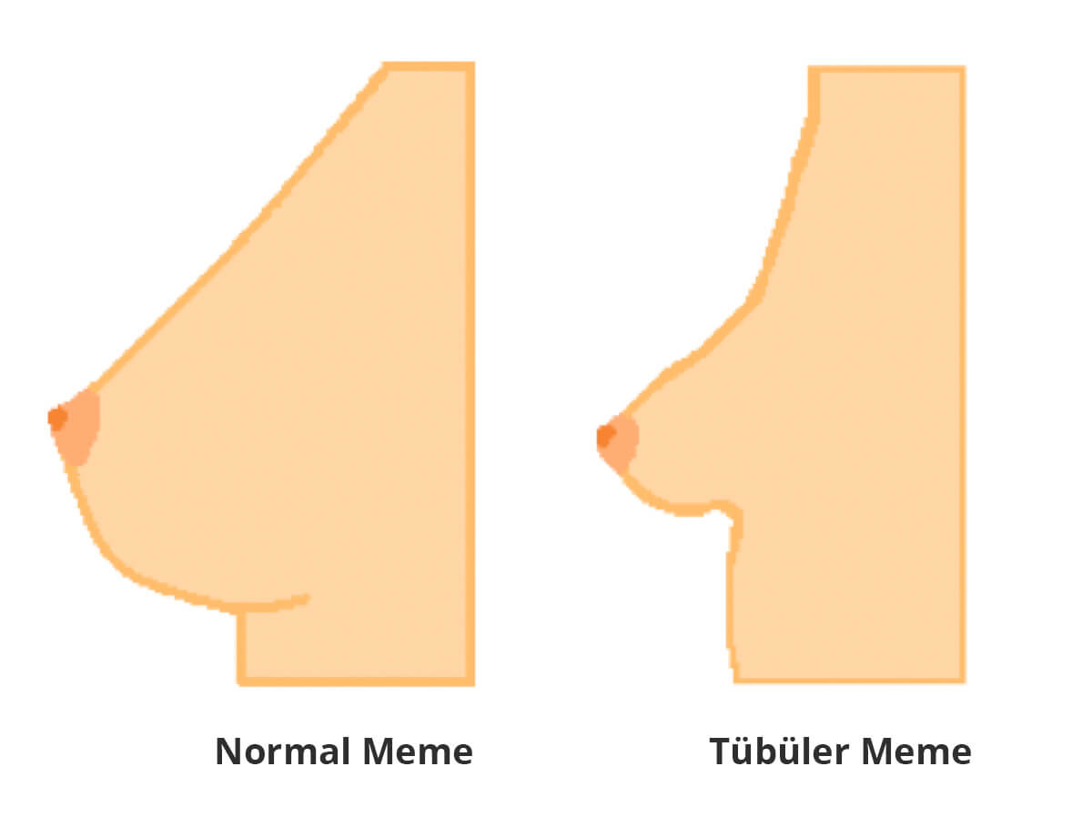 tubuler breast