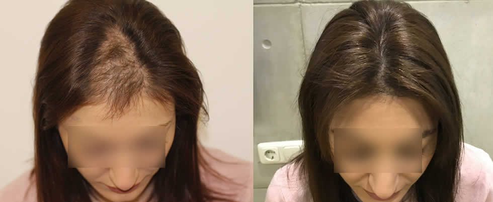 female hair transplant before after