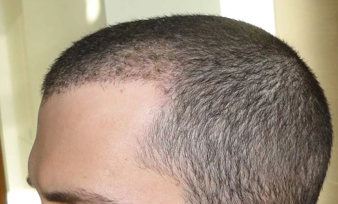 Do All Transplanted Hair Grow? Understanding Hair Growth after Hair  Transplantation