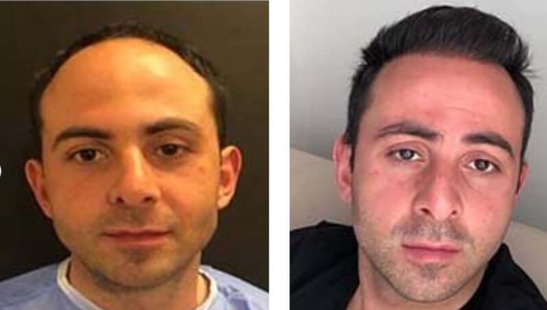 emphair hair transplant before after