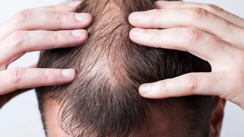 erkek tipi saç dökülmesi