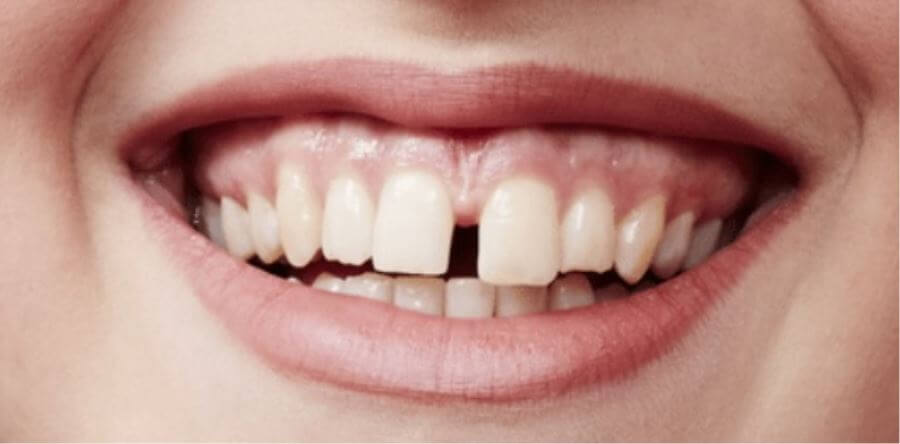 cavities in the teeth