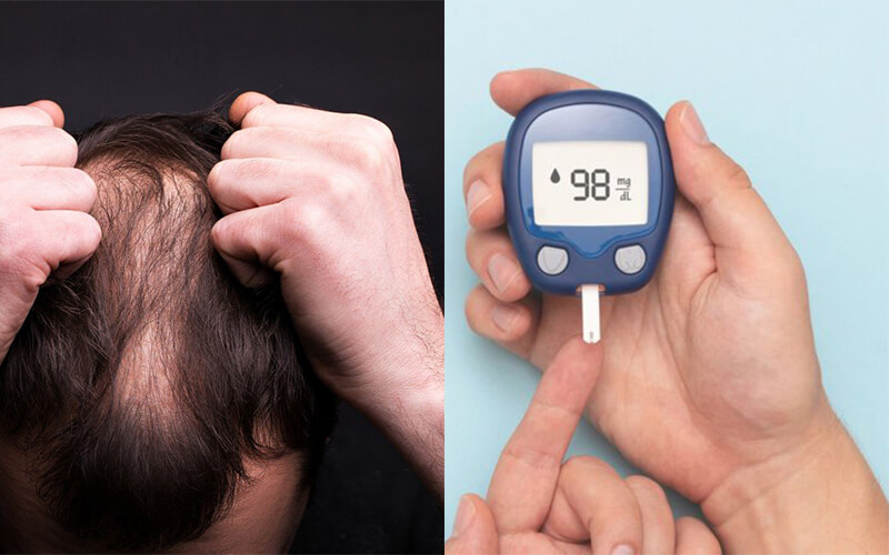 Can a Diabetic Go For Hair Transplant? | Newlyme