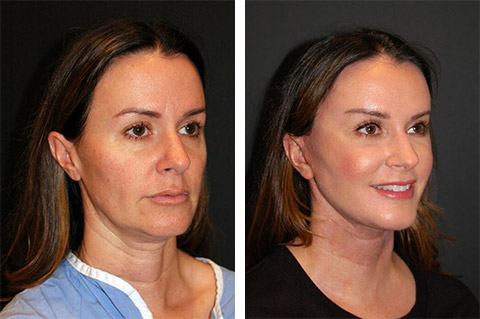 face lift before after