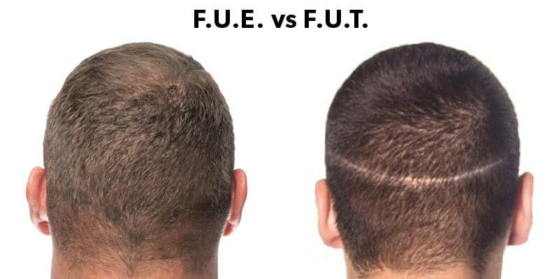 FUT ve FUE tekniği