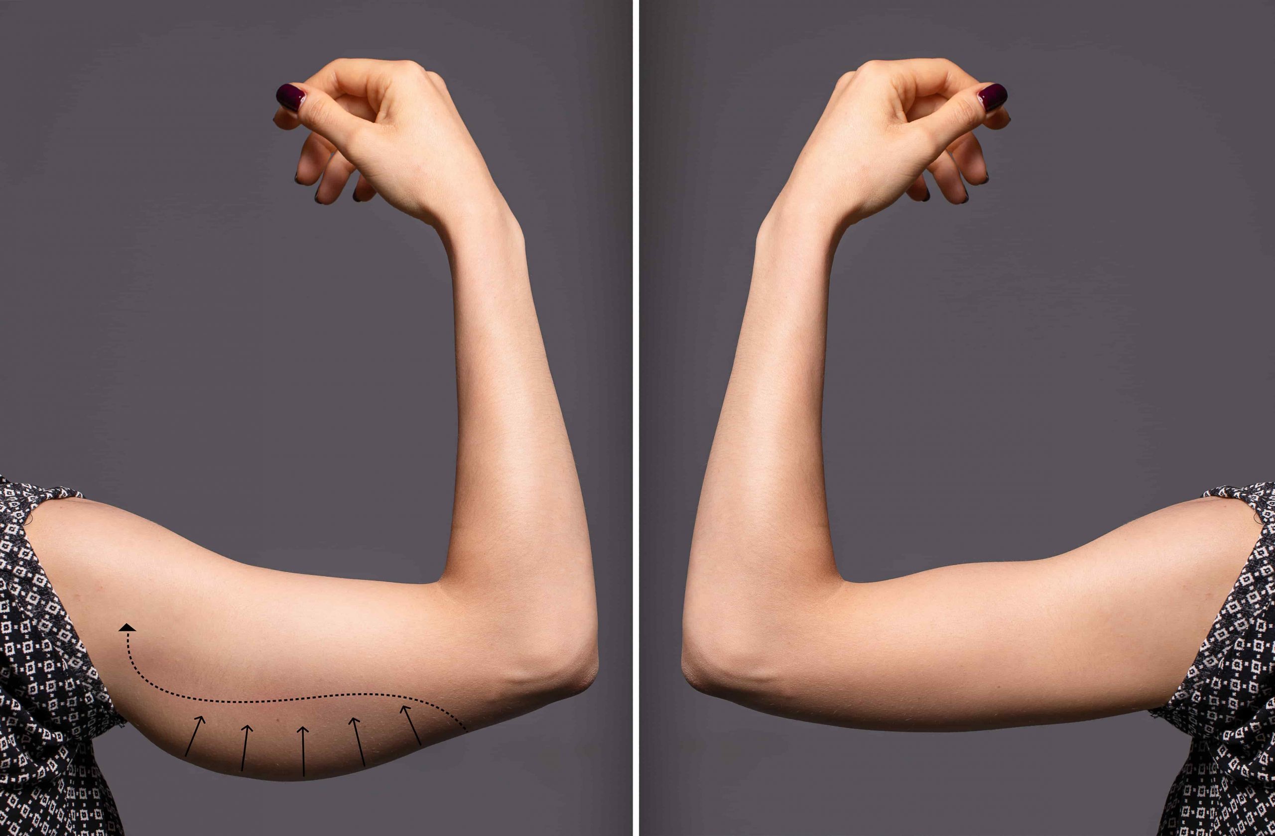 arm lift before after