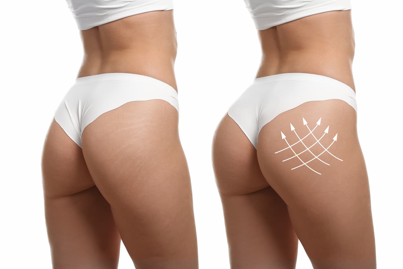 butt implant before and after