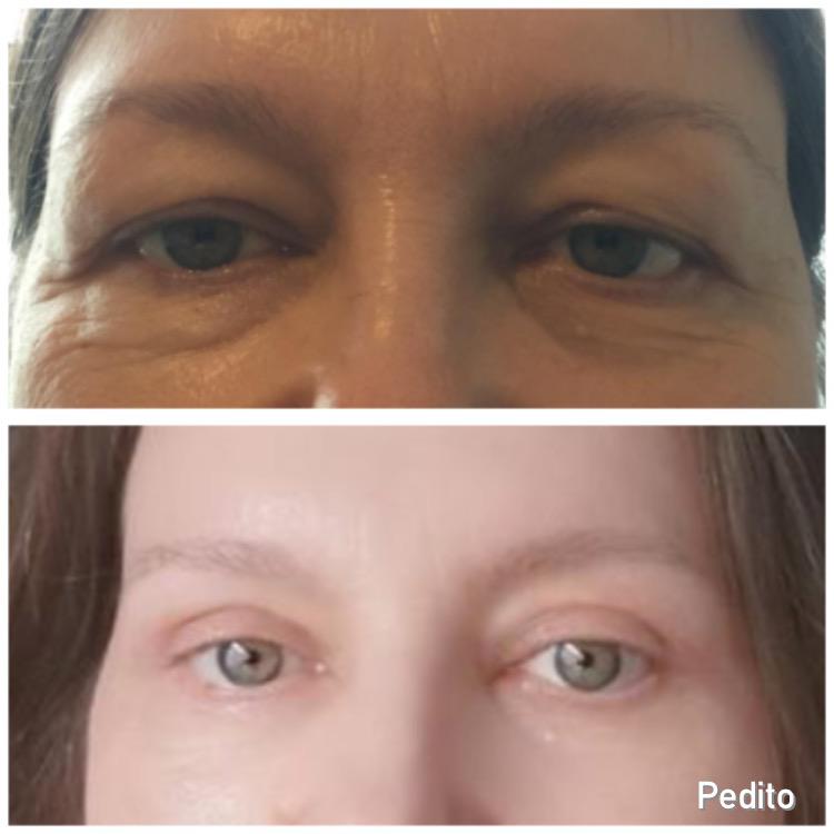 results of eyelid surgery