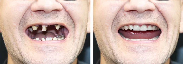 dental implant -2