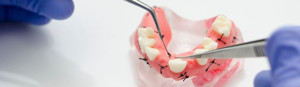 dental implant -3