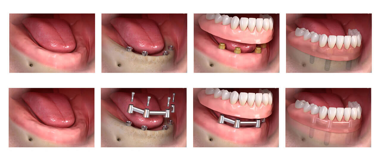 dental implant -4