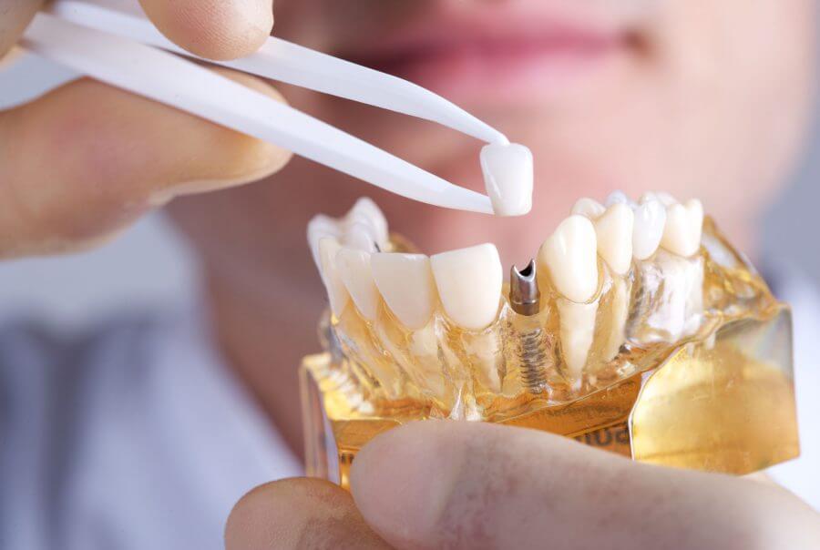 dental implant -5
