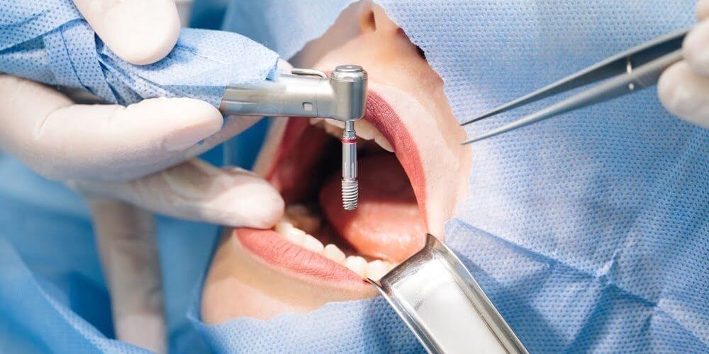dental implant -6