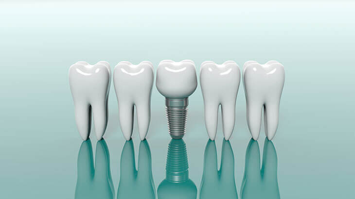 dental implant -7