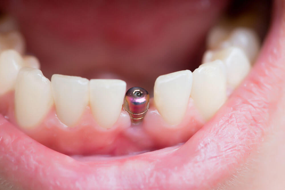 dental implant -8