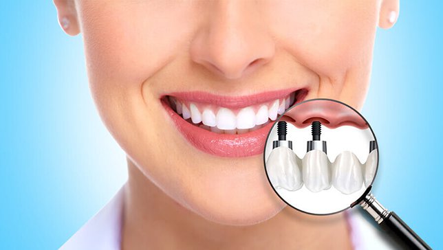 dental implant -9