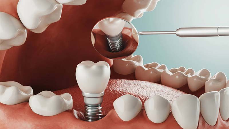 dental implant -10
