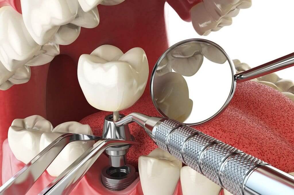 dental implant -11