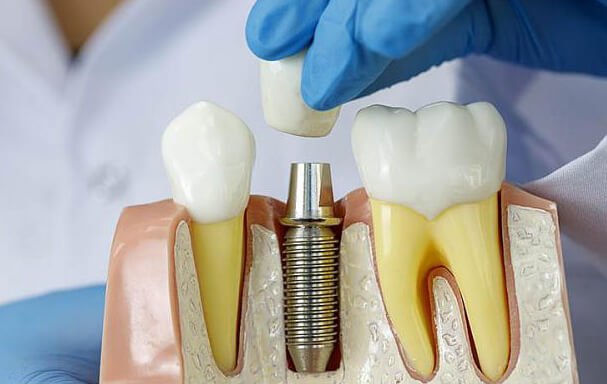 dental implant -13
