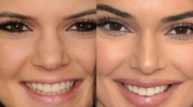 Kendall Jenner burun estetiği
