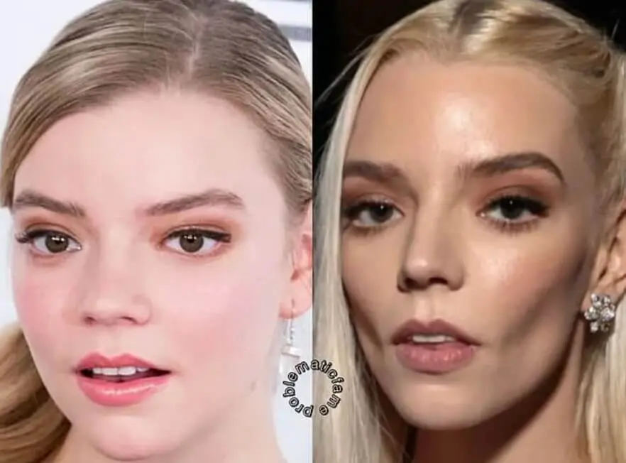 Anya Taylor bichectomy before after