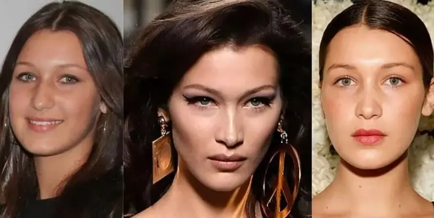 Bella Hadid bichectomy before after