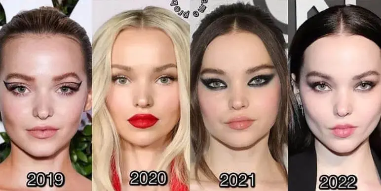 Dove Cameron bichectomy before after