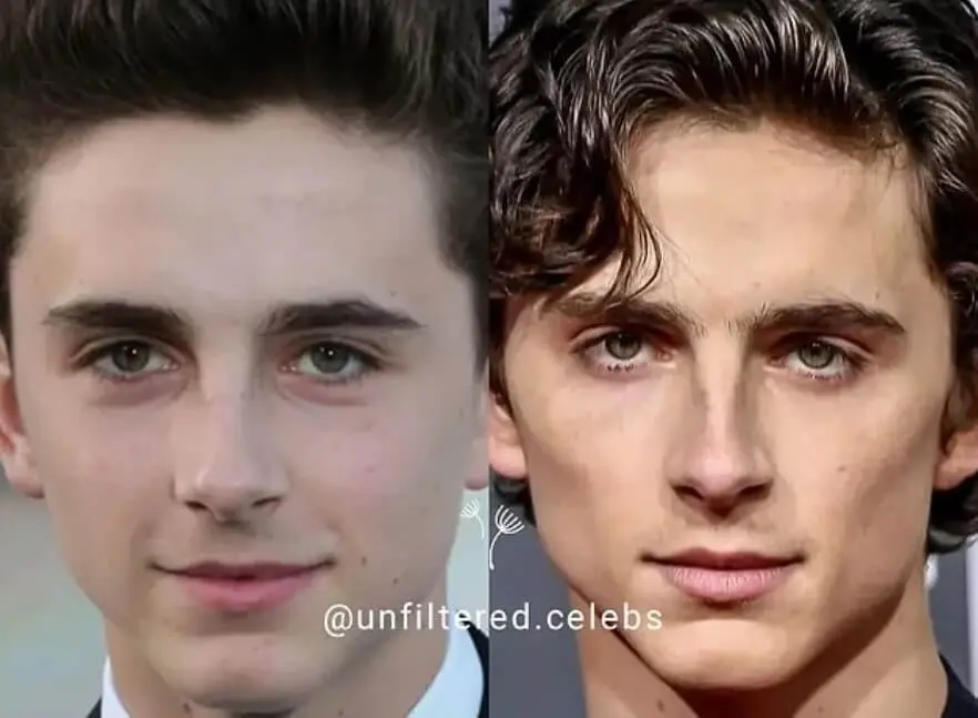 Timothee Chalamet bichectomy before after