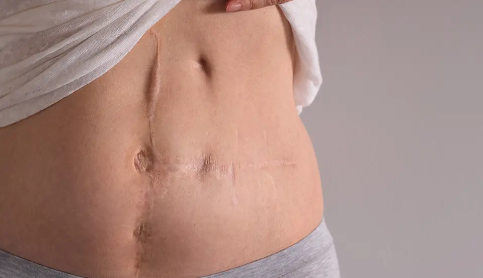scar on woman abdomen