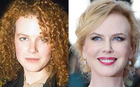 Nicole Kidman estetik öncesi sonrası