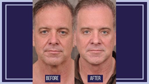 face lift before - after