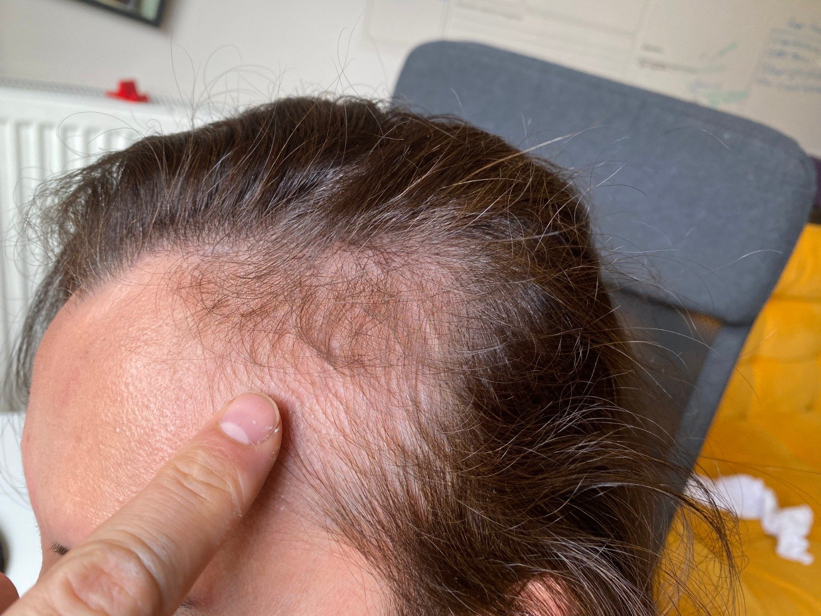 Hair transplantation in women: My hair grows in the form of feathers in  certain parts of my hair and cannot grow. Can hair transplantation be done  in this part? - Q&A | Newlyme