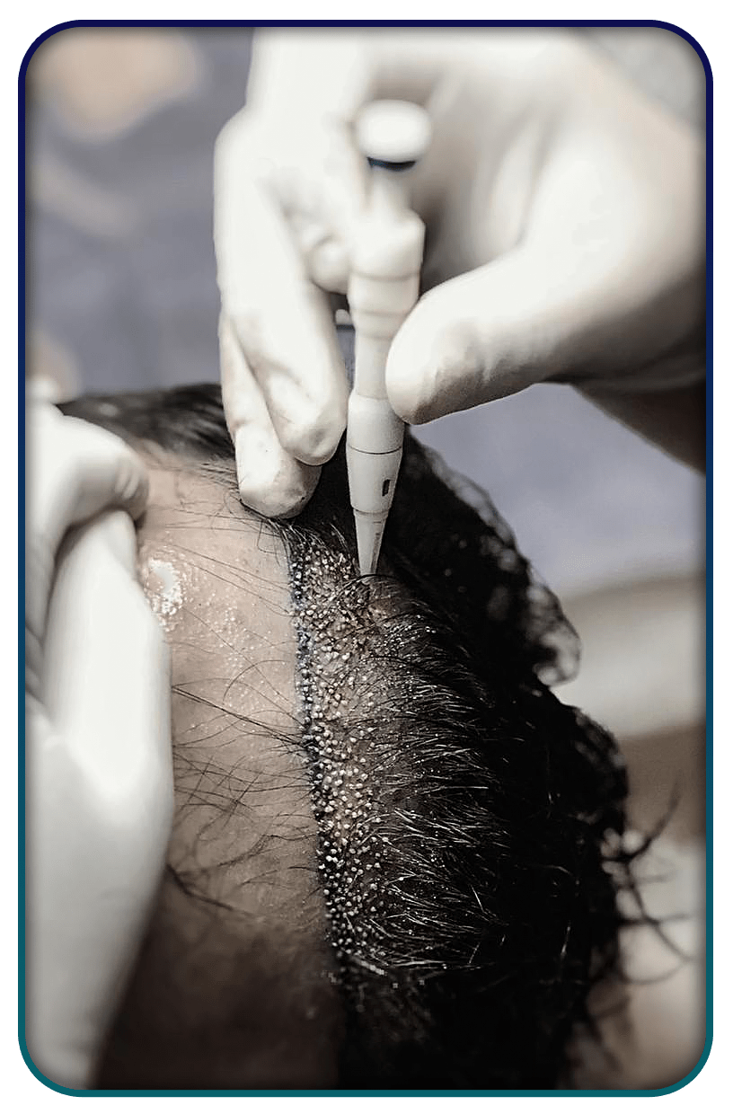 DHI saç ekimi yöntemi nasıl uygulanır