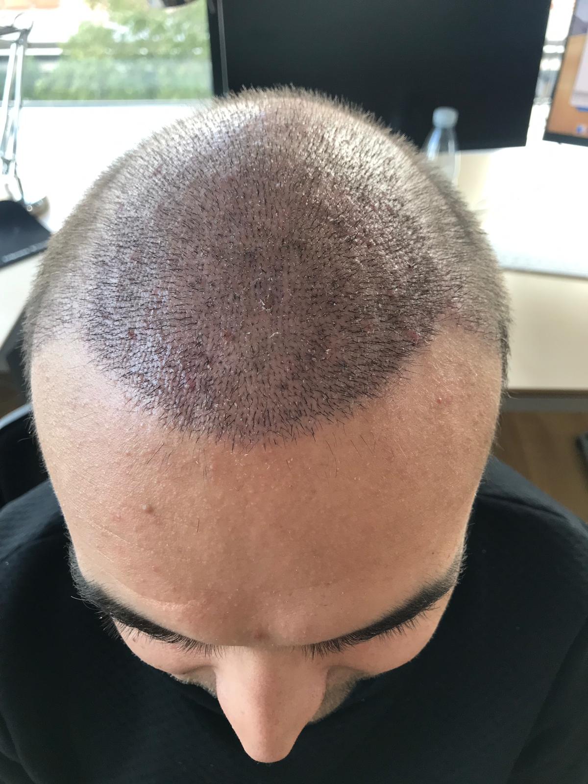I'm glad I had my hair transplant done by Sibel Ulusan. - Review | Newlyme