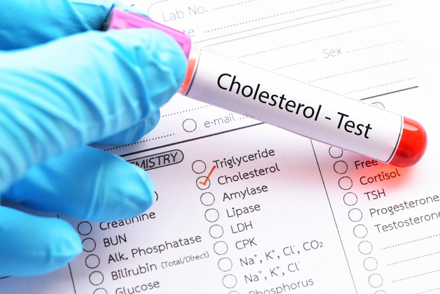 kolesterol testi