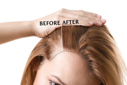 hair loss with prp