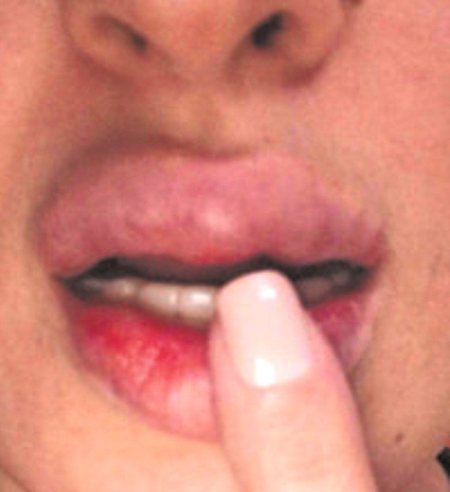 dudak damarı çatlaması