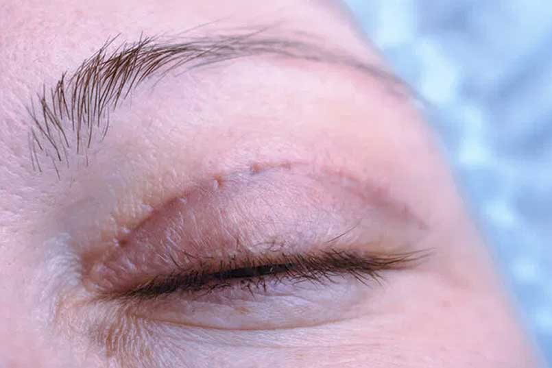 eyelid surgery recovery process is quite short