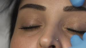 eyelid surgery can be suitable for everyone