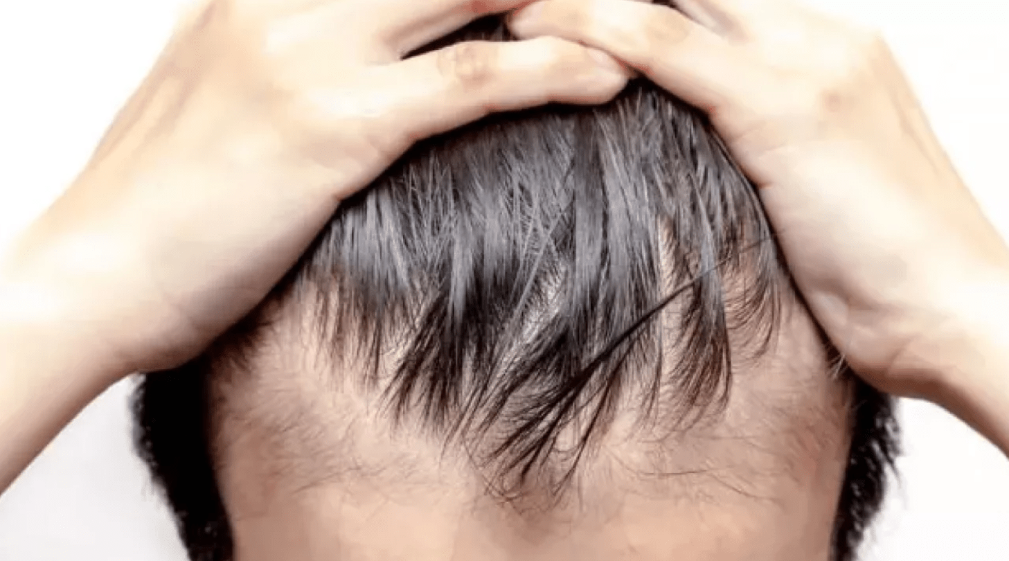 saç dökülme nedenleri